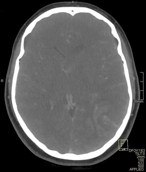 File:Cerebral venous sinus thrombosis (Radiopaedia 91329-108965 Axial venogram 43).jpg