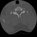 Cervical flexion teardrop fracture with cord hemorrhage (Radiopaedia 32497-33454 Axial bone window 68).jpg