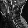 Cervical flexion teardrop fracture with cord hemorrhage (Radiopaedia 32497-33455 Sagittal T2 8).jpg