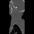 Cervical spine fractures with vertebral artery dissection (Radiopaedia 32135-33078 Sagittal bone window 2).jpg