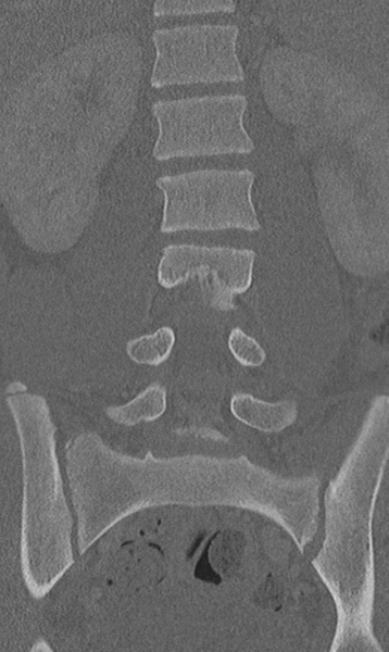 File:Chance fracture (Radiopaedia 40360-42912 Coronal bone window 33).png