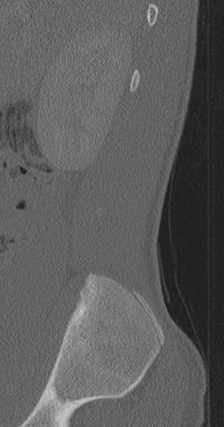 File:Chance fracture (Radiopaedia 40360-42912 Sagittal bone window 90).png
