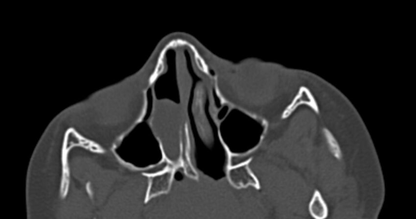 Choanal atresia (Radiopaedia 51295-56972 Axial bone window 28).jpg