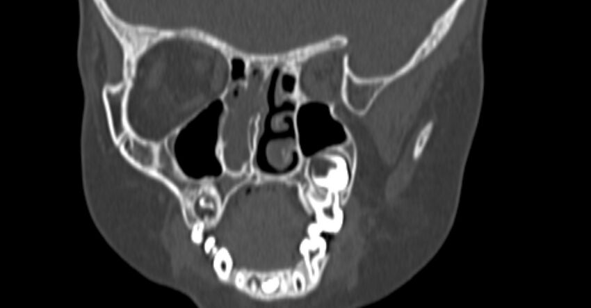 Choanal atresia (Radiopaedia 51295-56972 Coronal bone window 45).jpg