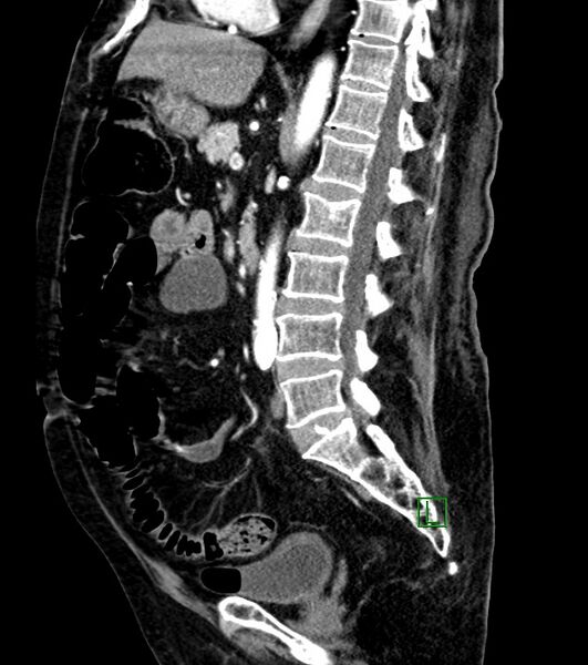 File:Cholangiocarcinoma with cerebral metastases (Radiopaedia 83519-98629 F 60).jpg