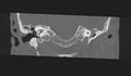 Cholesteatoma (Radiopaedia 10742-11203 Coronal bone window 9).jpg