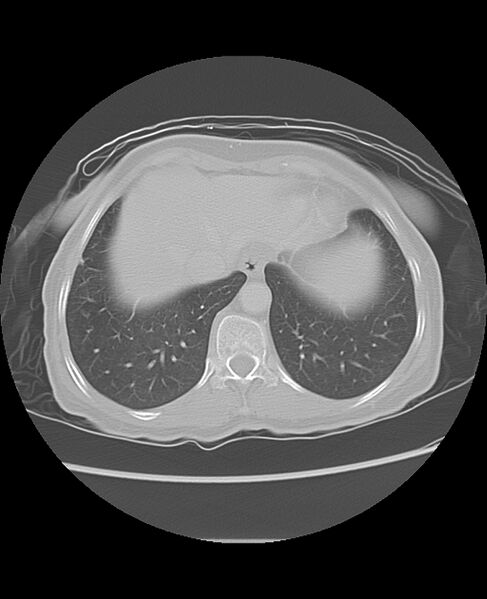File:Chondrosarcoma (Radiopaedia 79427-92532 Axial lung window 47).jpg