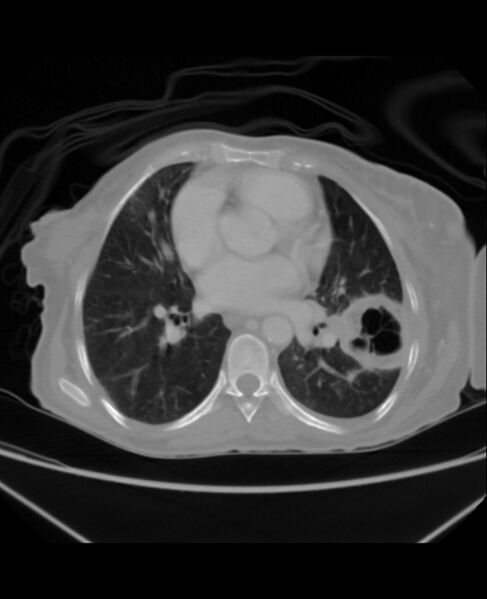 File:Chondrosarcoma (Radiopaedia 79427-92535 Axial lung window 30).jpg