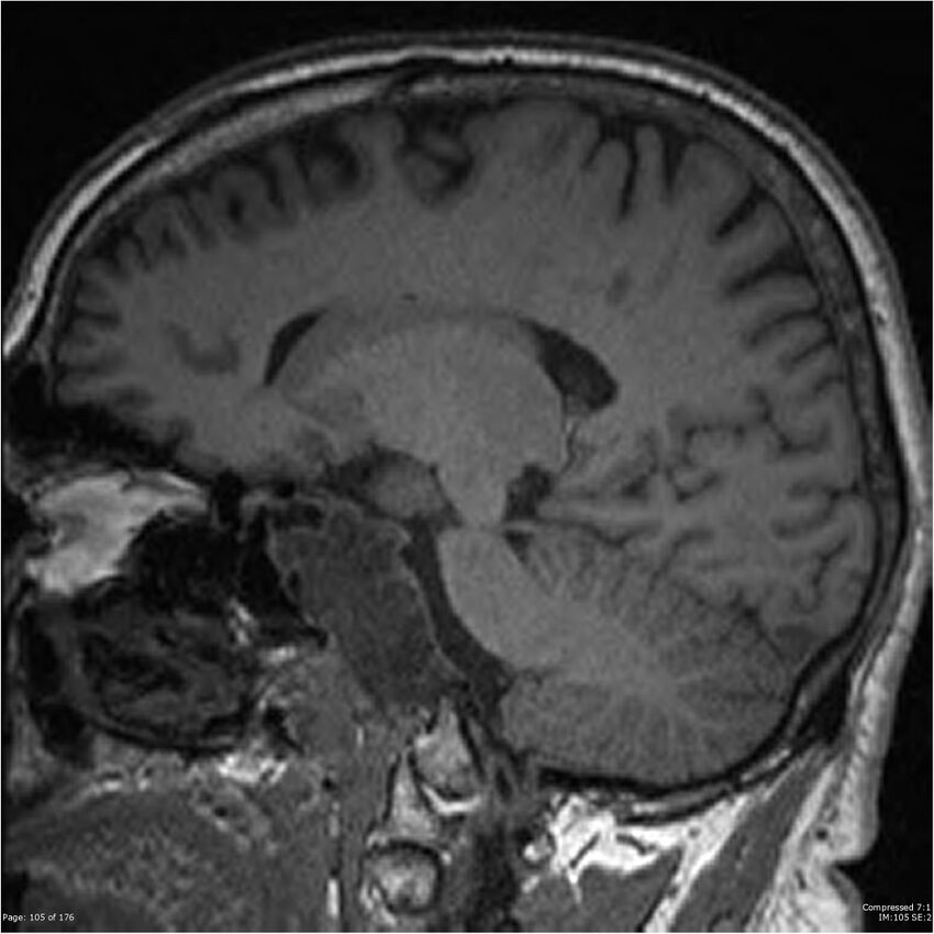Chondrosarcoma of skull base- grade II (Radiopaedia 40948-43654 Sagittal T1 28).jpg