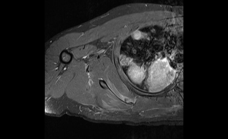 File:Choriocarcinoma in the shoulder (Radiopaedia 28603-28861 Axial T1 C+ fat sat 20).jpg