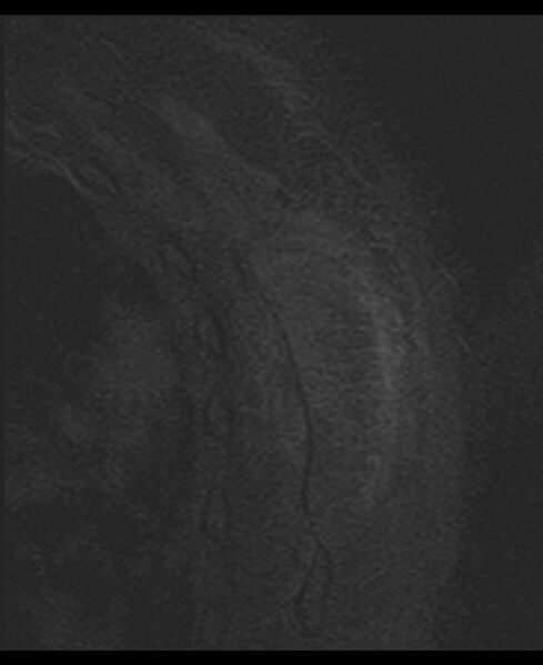 File:Choriocarcinoma in the shoulder (Radiopaedia 28603-28861 D 34).jpg