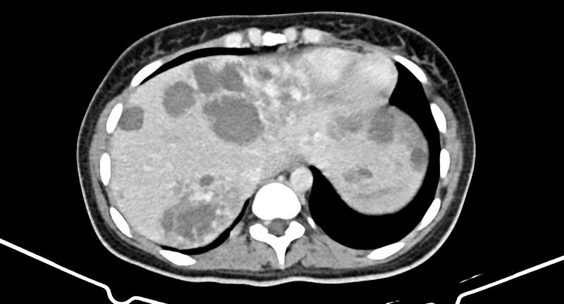 File:Choriocarcinoma liver metastases (Radiopaedia 74768-85766 A 33).jpg