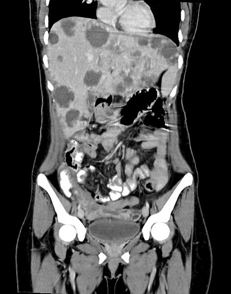 File:Choriocarcinoma liver metastases (Radiopaedia 74768-85766 B 43).jpg