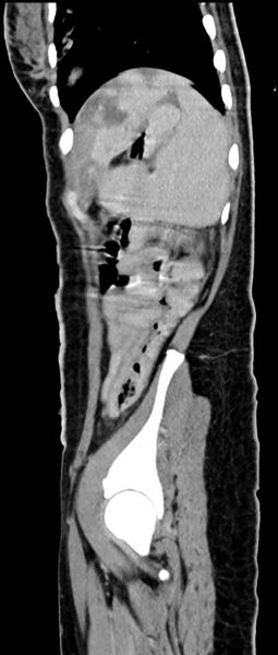 File:Choriocarcinoma liver metastases (Radiopaedia 74768-85766 C 57).jpg