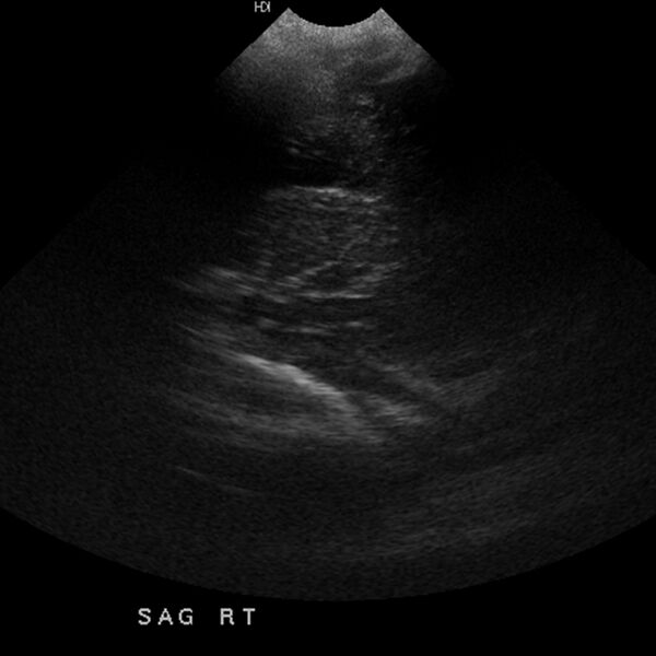 File:Choroid plexus carcinoma (Radiopaedia 21121-21033 A 8).jpg