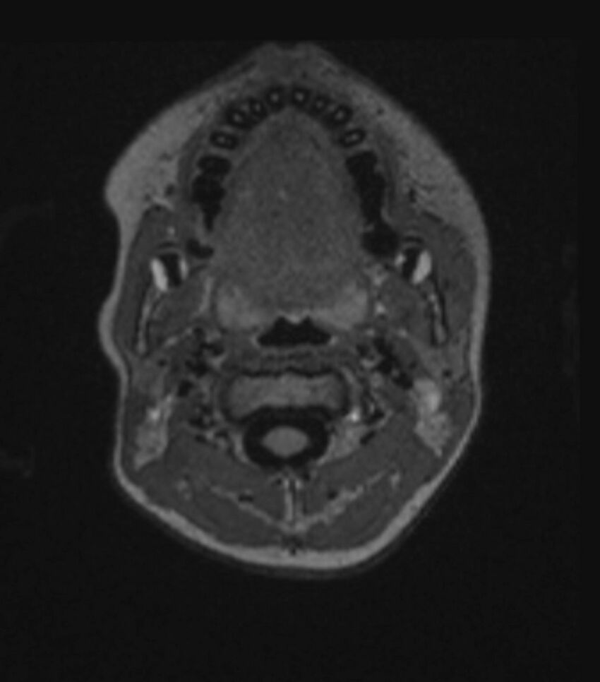 Choroid plexus carcinoma (Radiopaedia 91013-108553 Axial FLAIR C+ 47).jpg