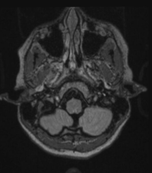 File:Choroid plexus carcinoma (Radiopaedia 91013-108553 Axial FLAIR C+ 81).jpg
