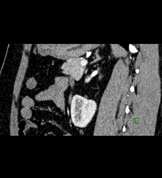 File:Chromophobe renal cell carcinoma (Radiopaedia 84286-99573 F 63).jpg