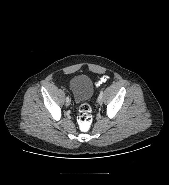 File:Chromophobe renal cell carcinoma (Radiopaedia 84337-99644 C 114).jpg