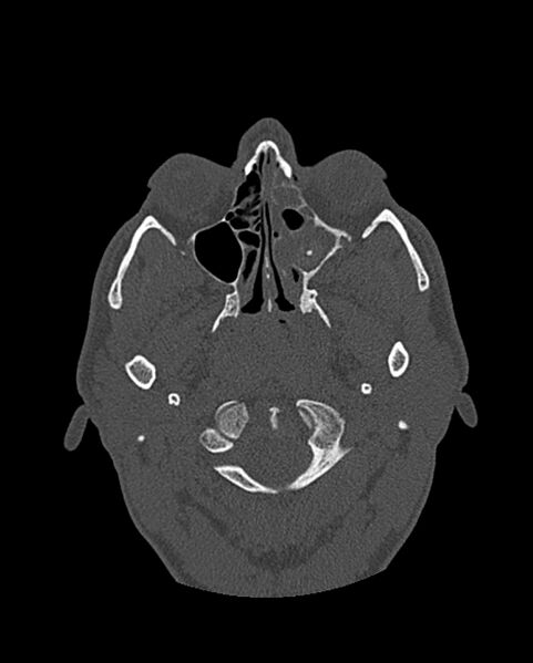 File:Chronic maxillary sinusitis caused by a foreign body (Radiopaedia 58521-65676 Axial bone window 161).jpg