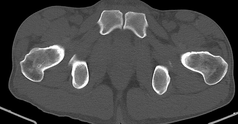 File:Chronic osteomyelitis (with sequestrum) (Radiopaedia 74813-85822 Axial non-contrast 45).jpg
