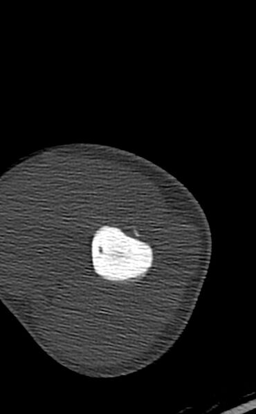 File:Chronic osteomyelitis of the distal humerus (Radiopaedia 78351-90971 Axial bone window 46).jpg