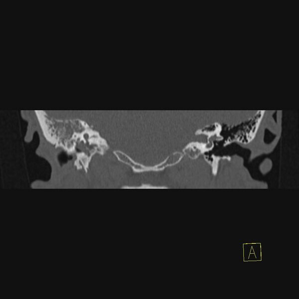 File:Chronic otitis media (Radiopaedia 14994-14912 Coronal bone window 6).JPEG