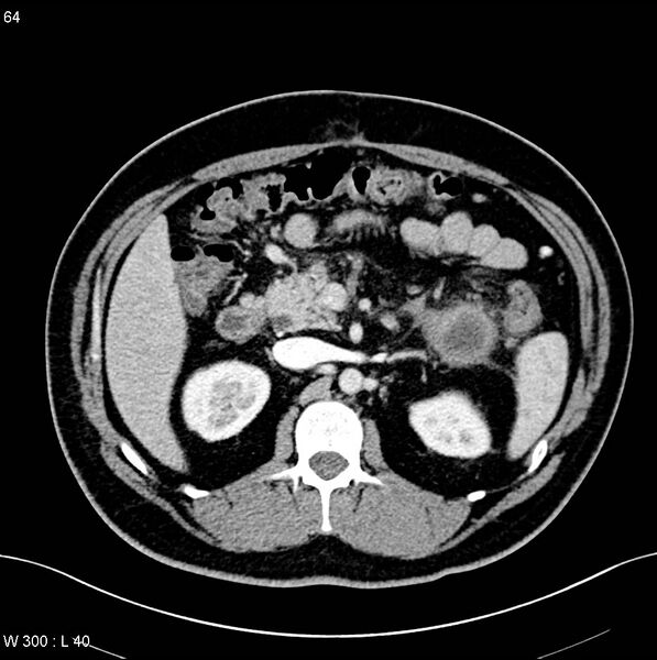 File:Chronic pancreatitis and pseudocysts (Radiopaedia 6724-7935 B 11).jpg