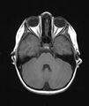 Chronic reactive multifocal osteomyelitis (CRMO) - mandible (Radiopaedia 56405-63069 Axial T1 25).jpg