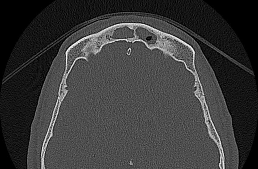 Chronic rhinosinusitis (Radiopaedia 65079-74075 Axial bone window 75).jpg