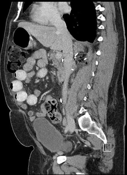 File:Closed loop obstruction - internal hernia into nephrectomy bed (Radiopaedia 59867-67320 C 56).jpg