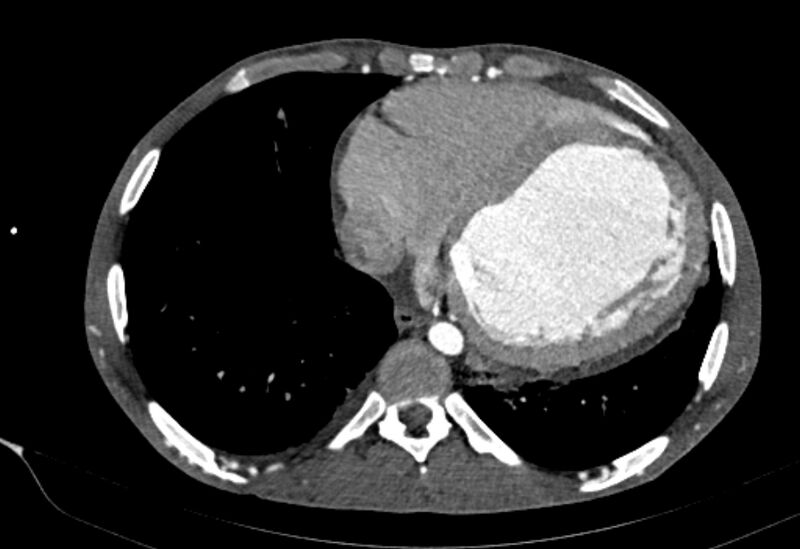 File:Coarctation of aorta with aortic valve stenosis (Radiopaedia 70463-80574 A 161).jpg