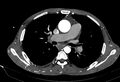 Coarctation of aorta with aortic valve stenosis (Radiopaedia 70463-80574 A 81).jpg