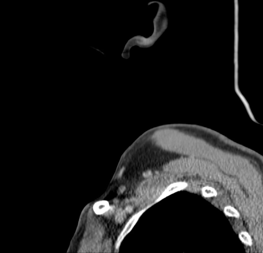 Colloid cyst of thyroid (Radiopaedia 22897-22923 Sagittal C+ delayed 3).jpg
