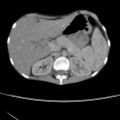 Colocolic fistula - Crohn disease (Radiopaedia 57063-63955 A 18).jpg