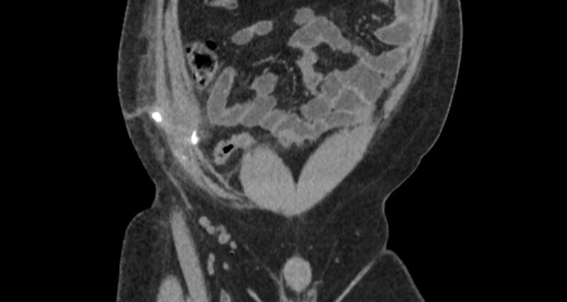 File:Colocutaneous fistula (Radiopaedia 56401-63062 C 22).jpg
