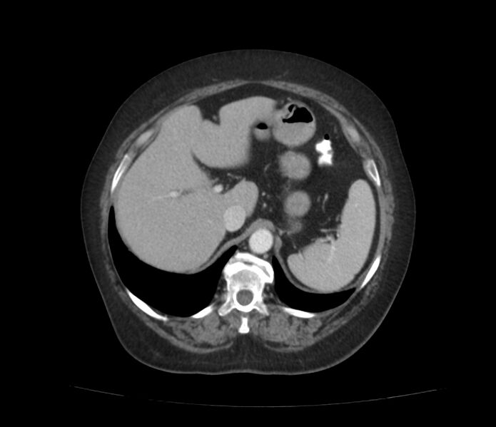 File:Colonic diverticulosis (Radiopaedia 22934-22957 A 16).jpg