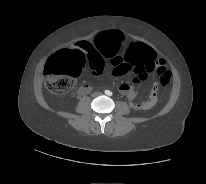 File:Colonic pseudo-obstruction (Radiopaedia 79752-92980 A 109).png