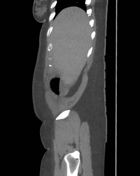 File:Colonic pseudo-obstruction (Radiopaedia 79752-92980 C 14).png