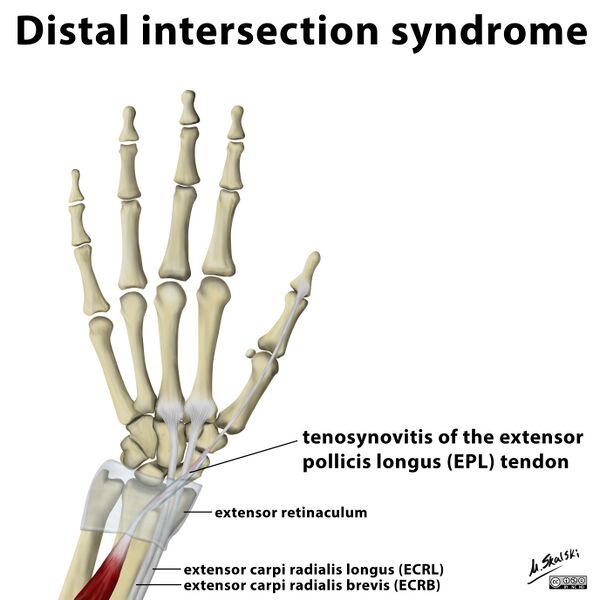 File:Distal intersection syndrome illustration (Radiopaedia 30184).jpg