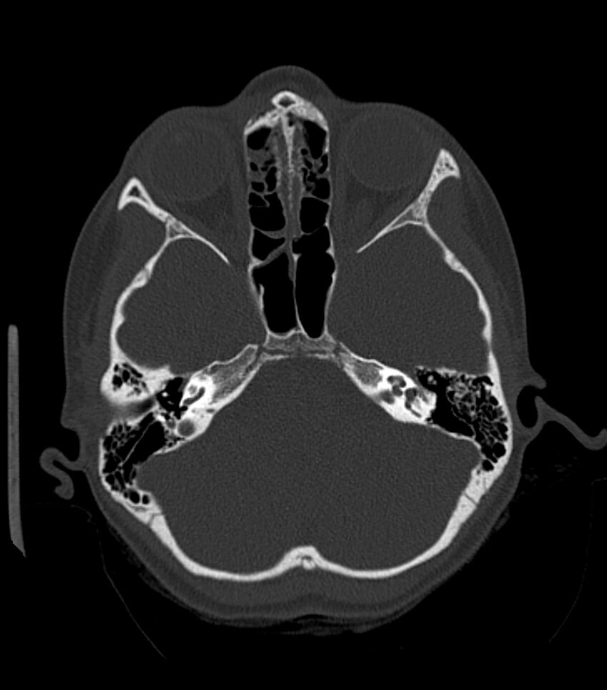 Nasoorbitoethmoid fracture (Radiopaedia 90044-107205 Axial bone window 81).jpg