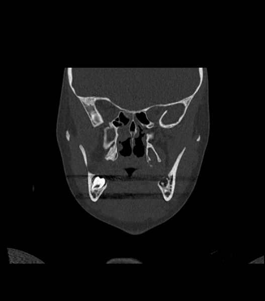 File:Nasoorbitoethmoid fracture (Radiopaedia 90044-107205 Coronal bone window 63).jpg