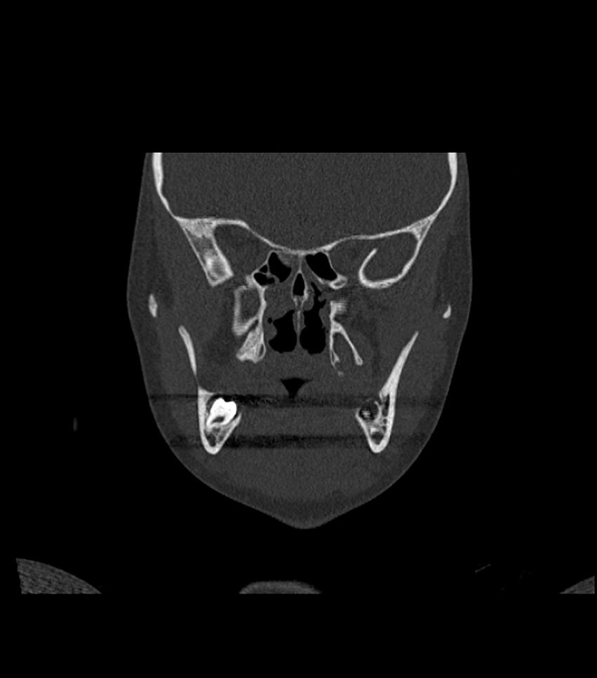 Nasoorbitoethmoid fracture (Radiopaedia 90044-107205 Coronal bone window 63).jpg