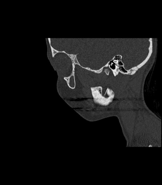 File:Nasoorbitoethmoid fracture (Radiopaedia 90044-107205 Sagittal bone window 111).jpg