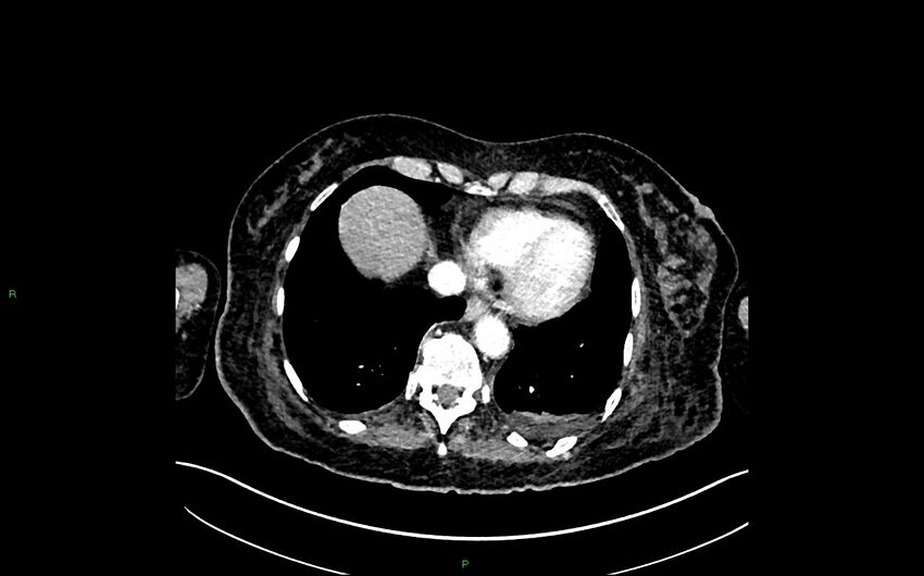 Neo-terminal ileal stricture (Crohn disease) (Radiopaedia 33790-34948 A 19).jpg