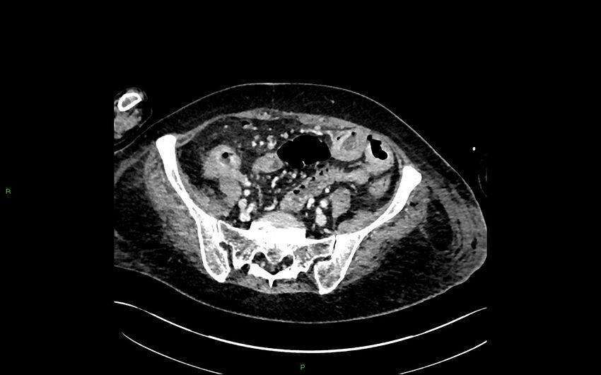 Neo-terminal ileal stricture (Crohn disease) (Radiopaedia 33790-34948 A 351).jpg
