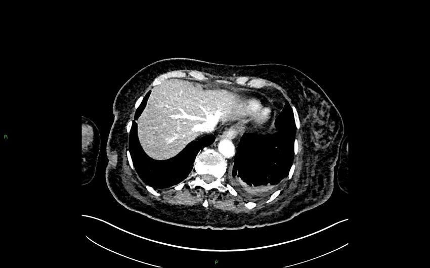 Neo-terminal ileal stricture (Crohn disease) (Radiopaedia 33790-34948 A 43).jpg