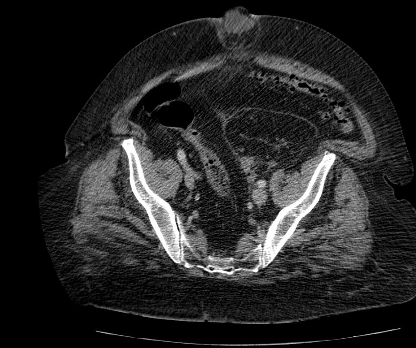 Nephroptosis with inguinal hernia containing perirenal fat (Radiopaedia 56632-63391 C 277).jpg