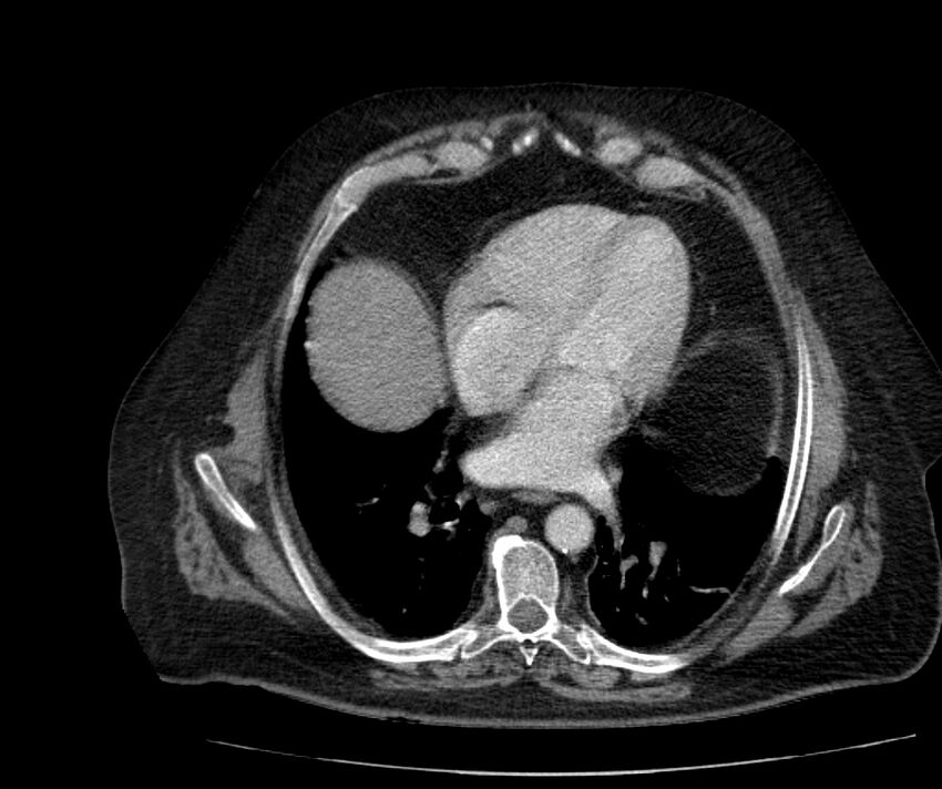 Nephroptosis with inguinal hernia containing perirenal fat (Radiopaedia 56632-63391 C 30).jpg