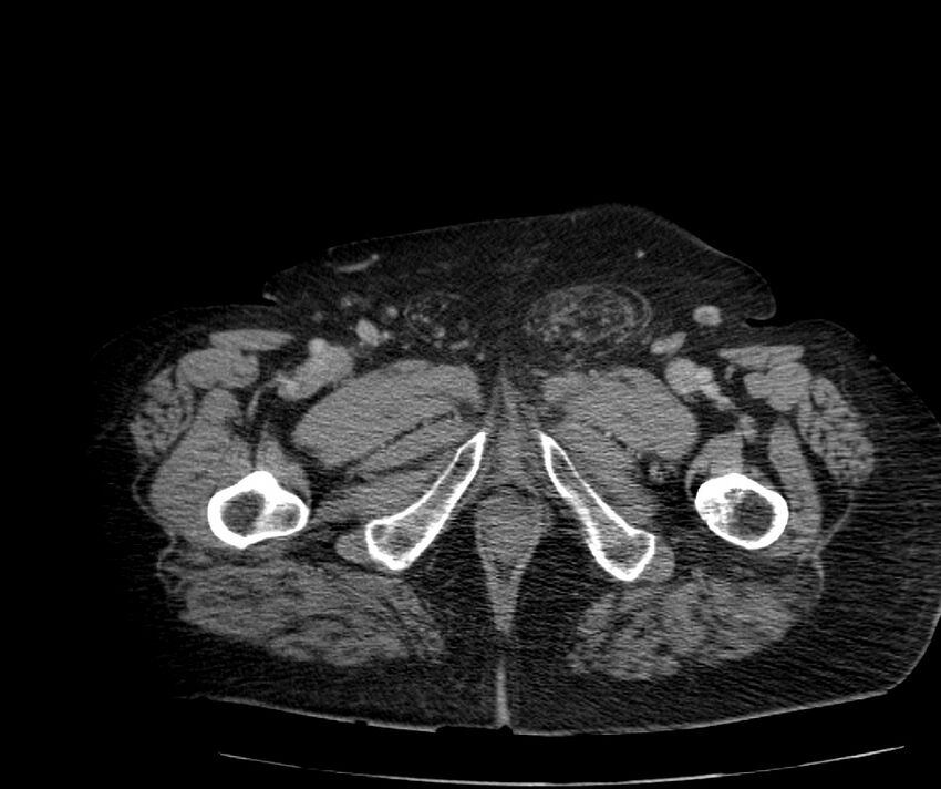 Nephroptosis with inguinal hernia containing perirenal fat (Radiopaedia 56632-63391 C 349).jpg